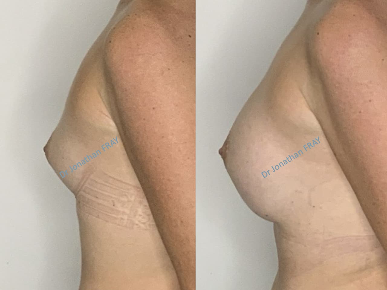 Exemple de résultat de pose d'implants mammaires par le Dr Fray à La Réunion - Vue 1