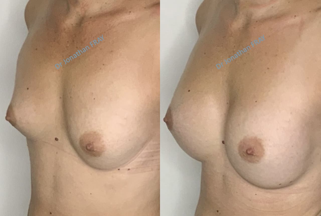 Exemple de résultat de pose d'implants mammaires par le Dr Fray à La Réunion - Vue 2