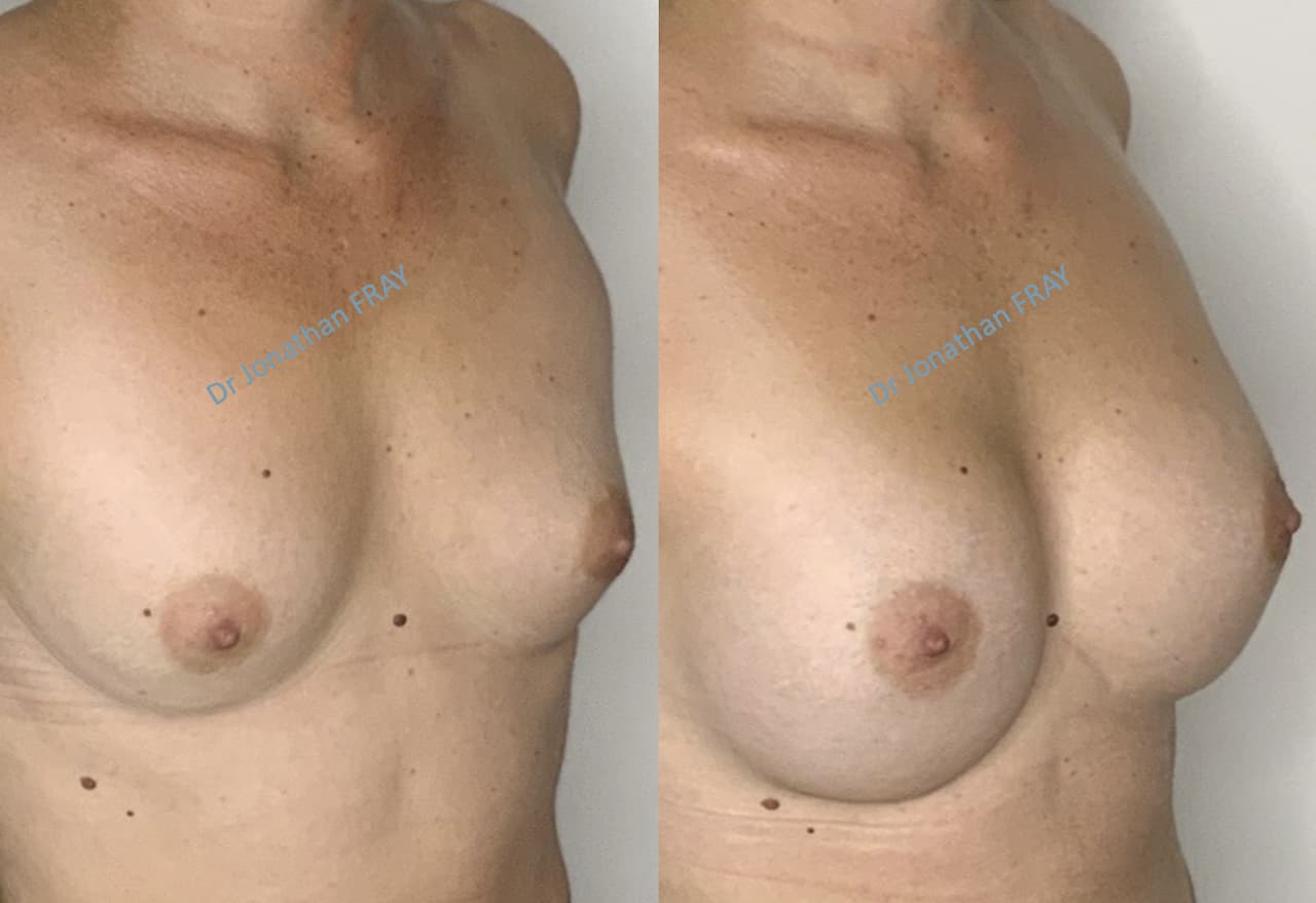 Exemple de résultat de pose d'implants mammaires par le Dr Fray à La Réunion - Vue 5