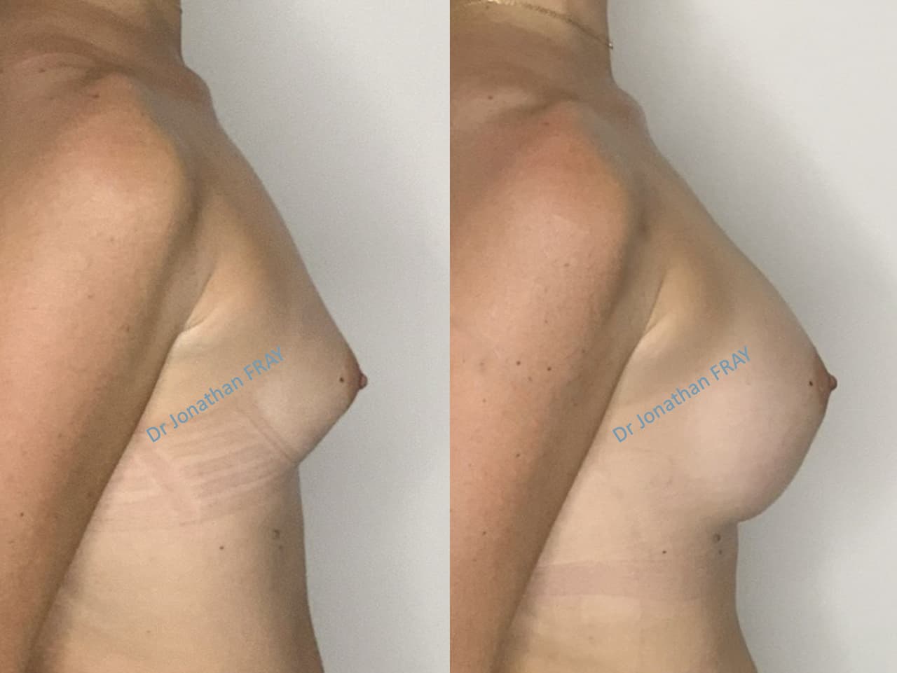 Exemple de résultat de pose d'implants mammaires par le Dr Fray à La Réunion - Vue 6