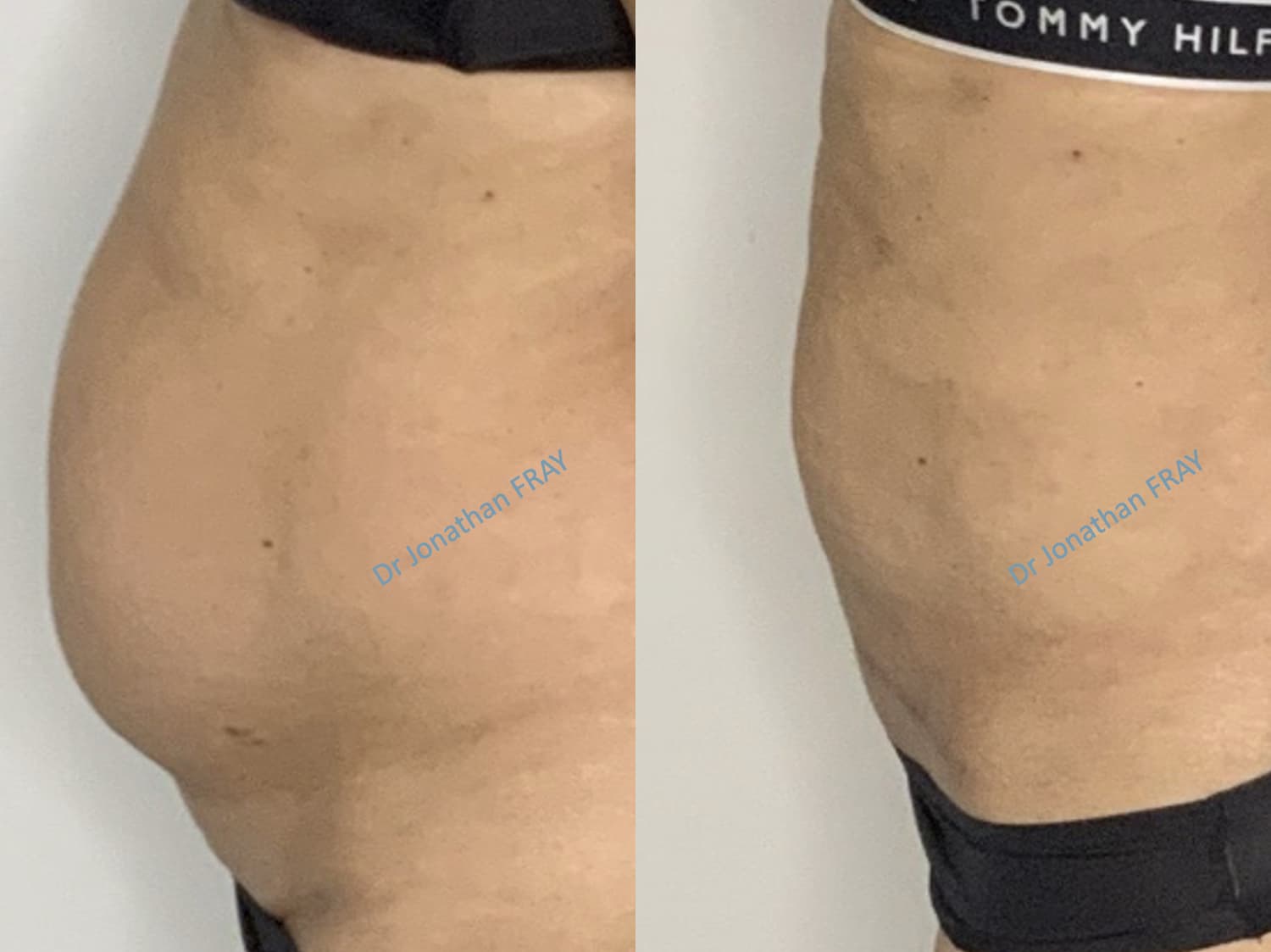 Photos avant après de mini plastie abdominale - vue 3