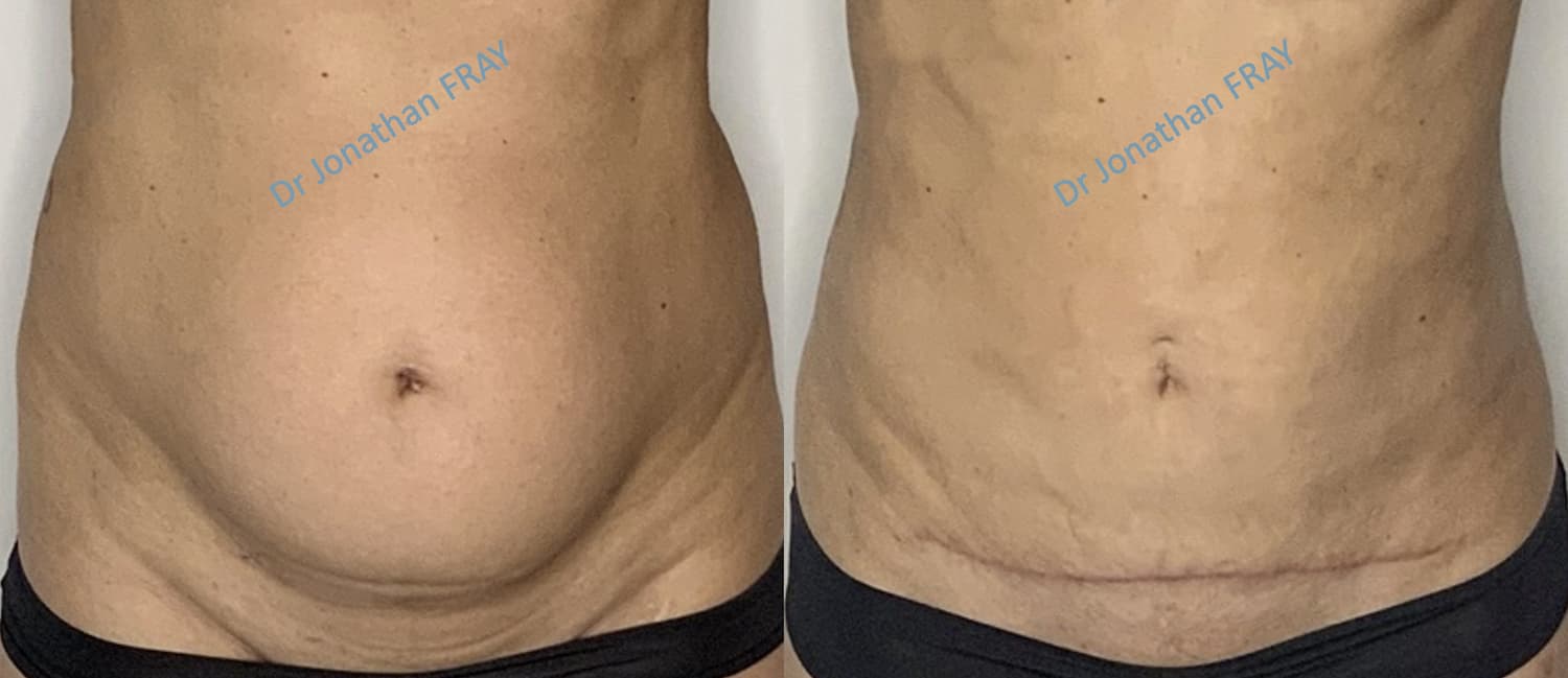 Photos avant après de mini plastie abdominale - vue 2