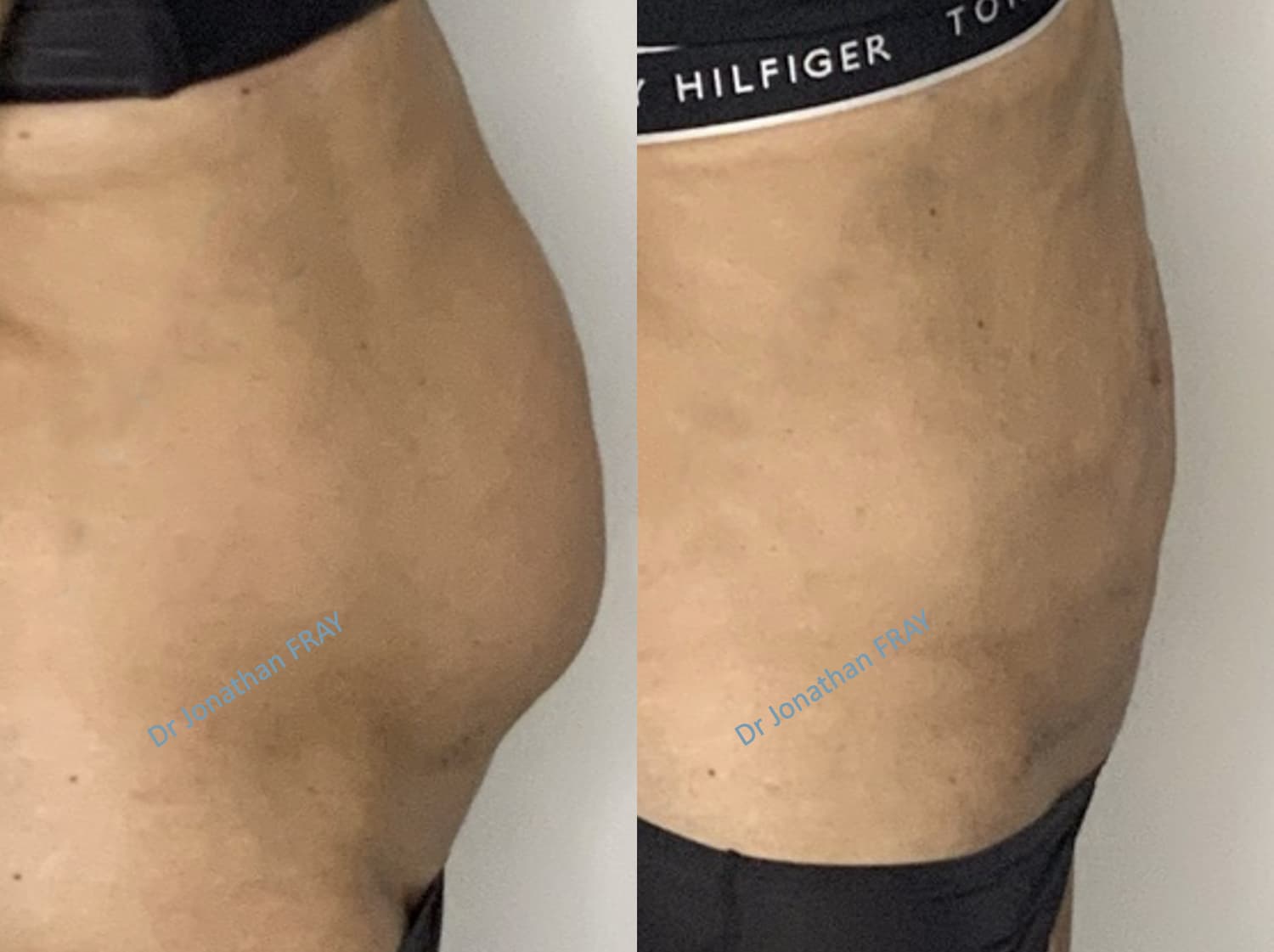 Photos avant après de mini plastie abdominale - vue 1