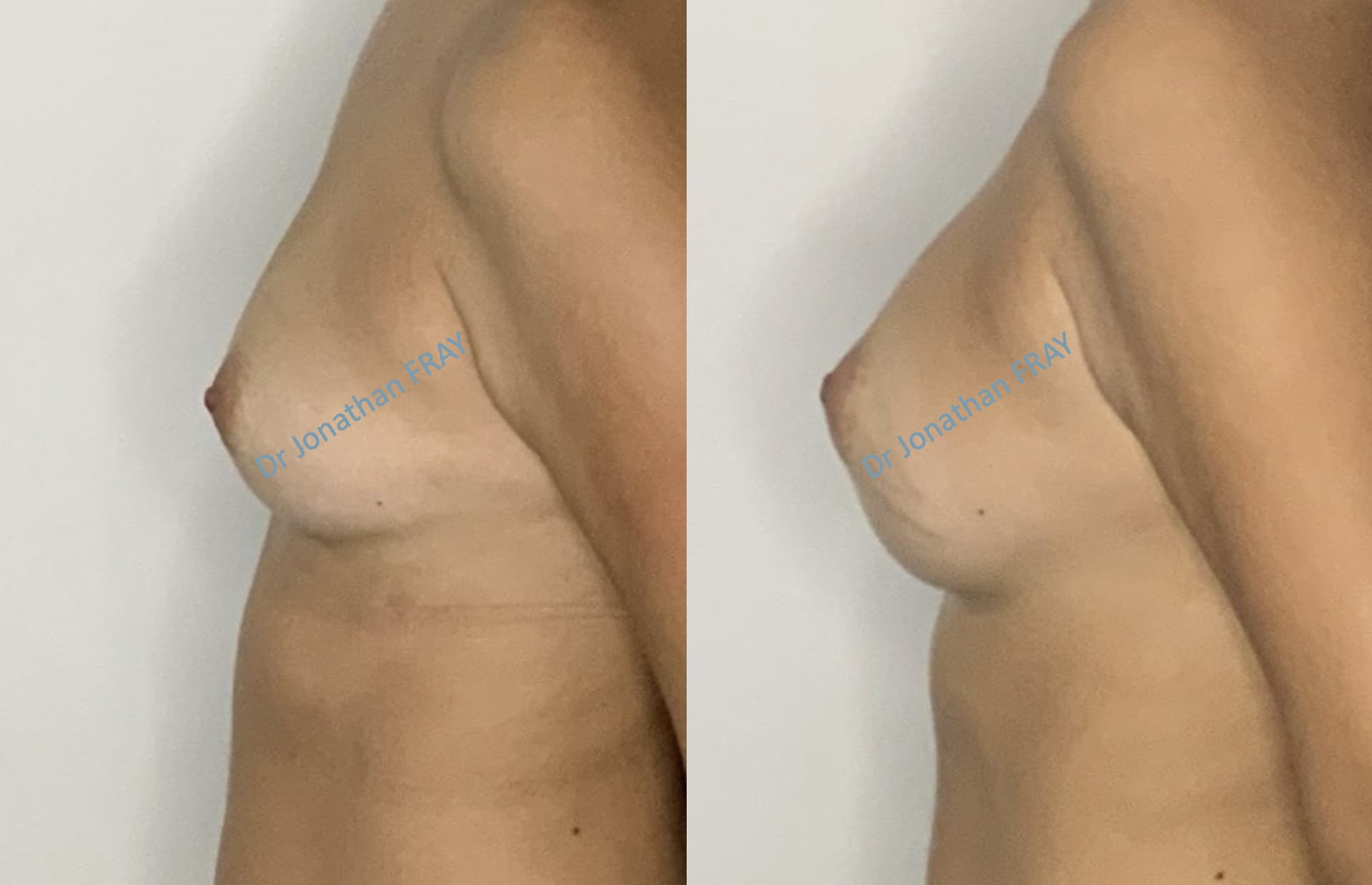 Photos avant après d'une augmentation mammaire réalisée par le Dr Fray à La Réunion - Vue 1