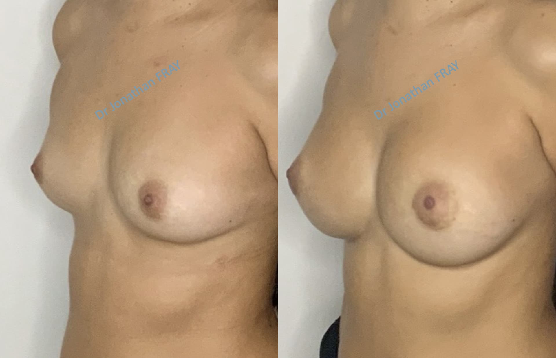 Photos avant après d'une augmentation mammaire réalisée par le Dr Fray à La Réunion - Vue 2