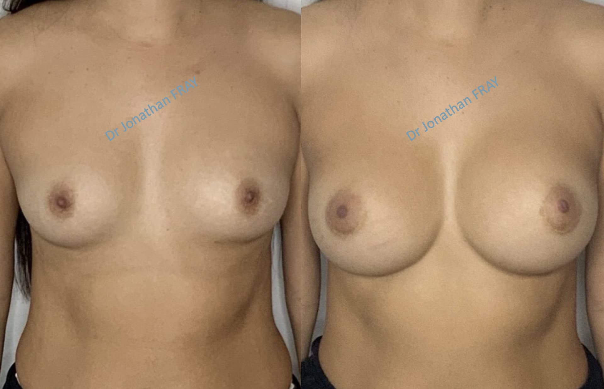 Photos avant après d'une augmentation mammaire réalisée par le Dr Fray à La Réunion - Vue 3
