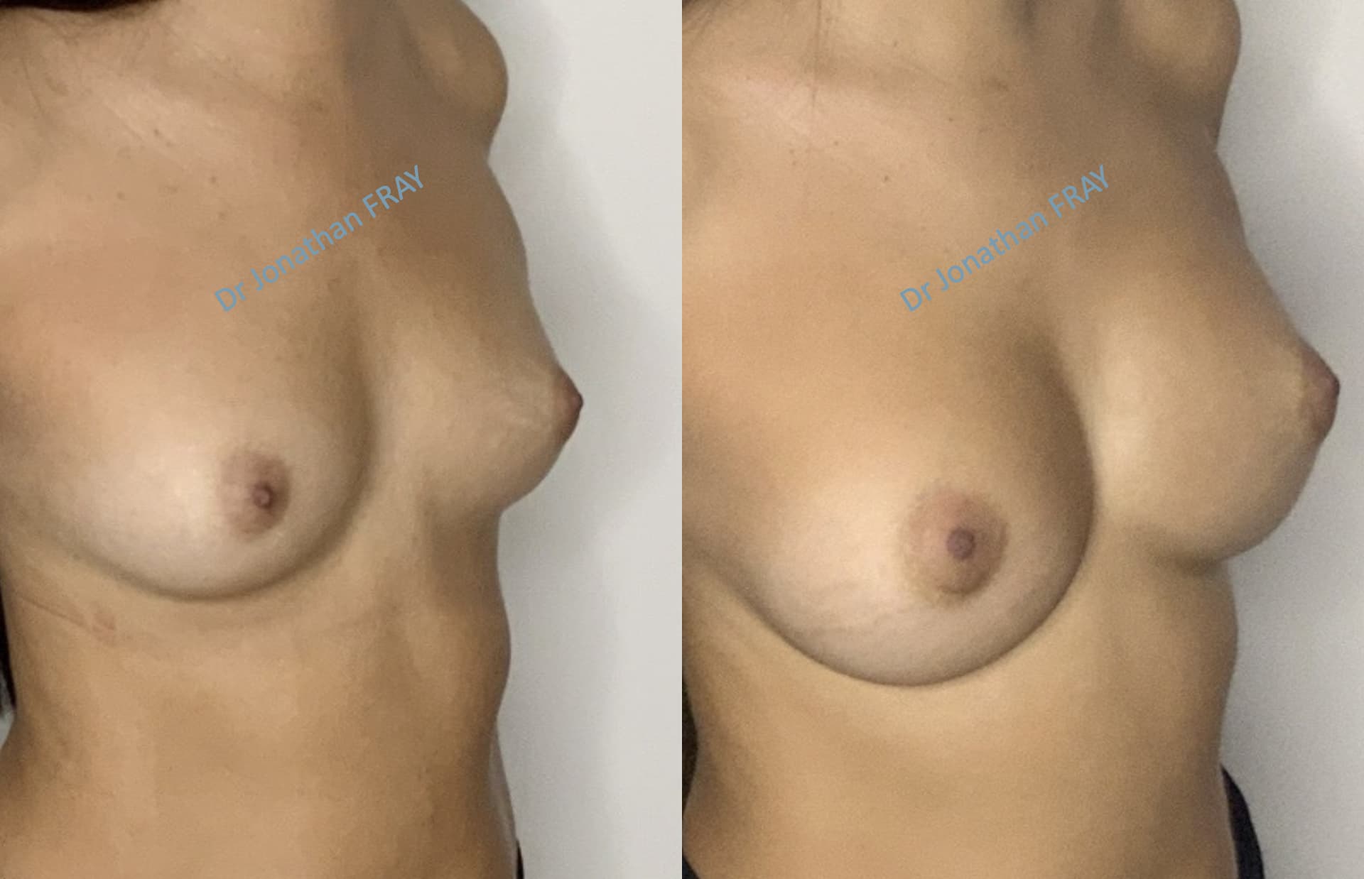 Photos avant après d'une augmentation mammaire réalisée par le Dr Fray à La Réunion - Vue 5