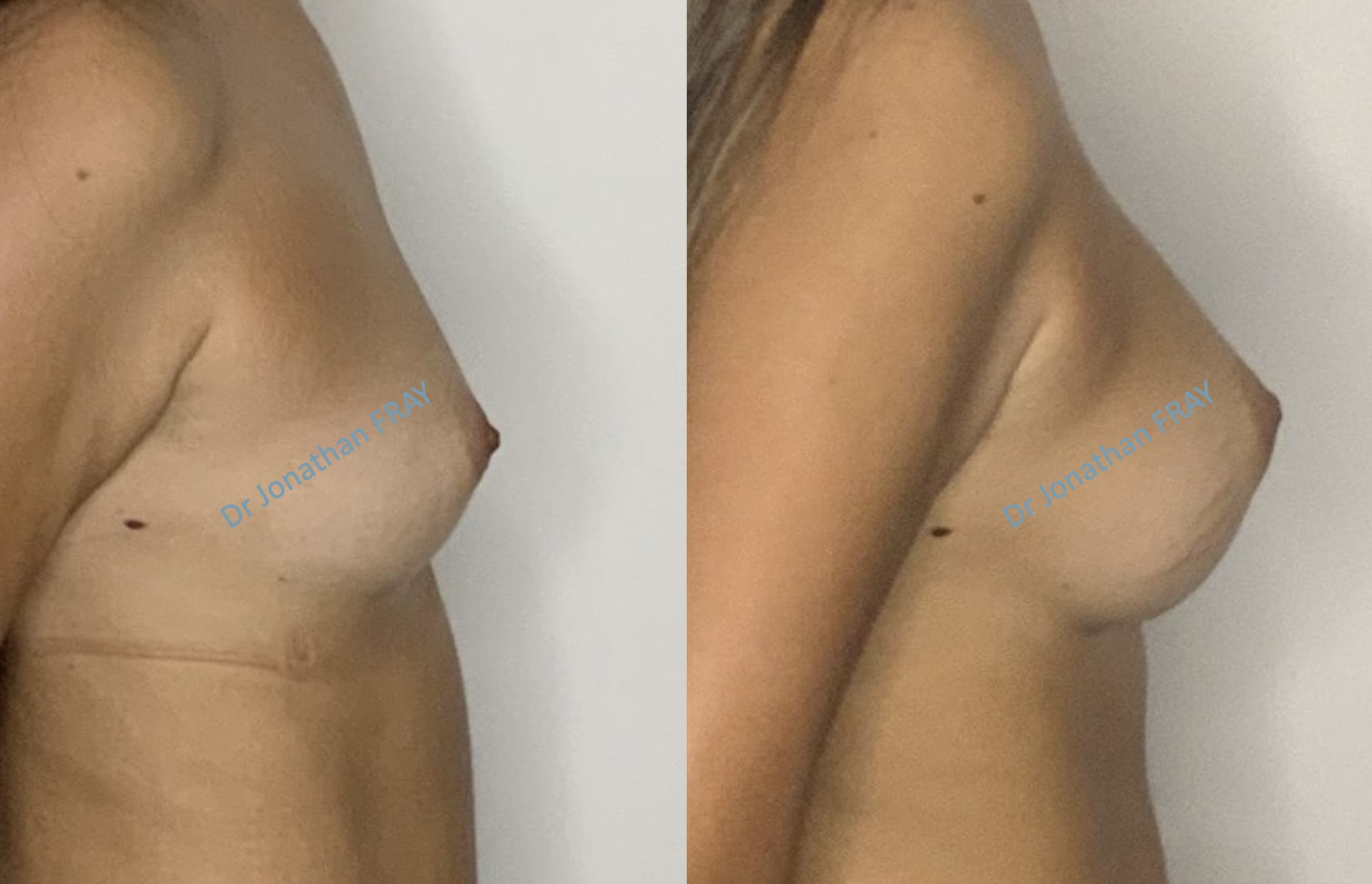 Photos avant après d'une augmentation mammaire réalisée par le Dr Fray à La Réunion - Vue 6