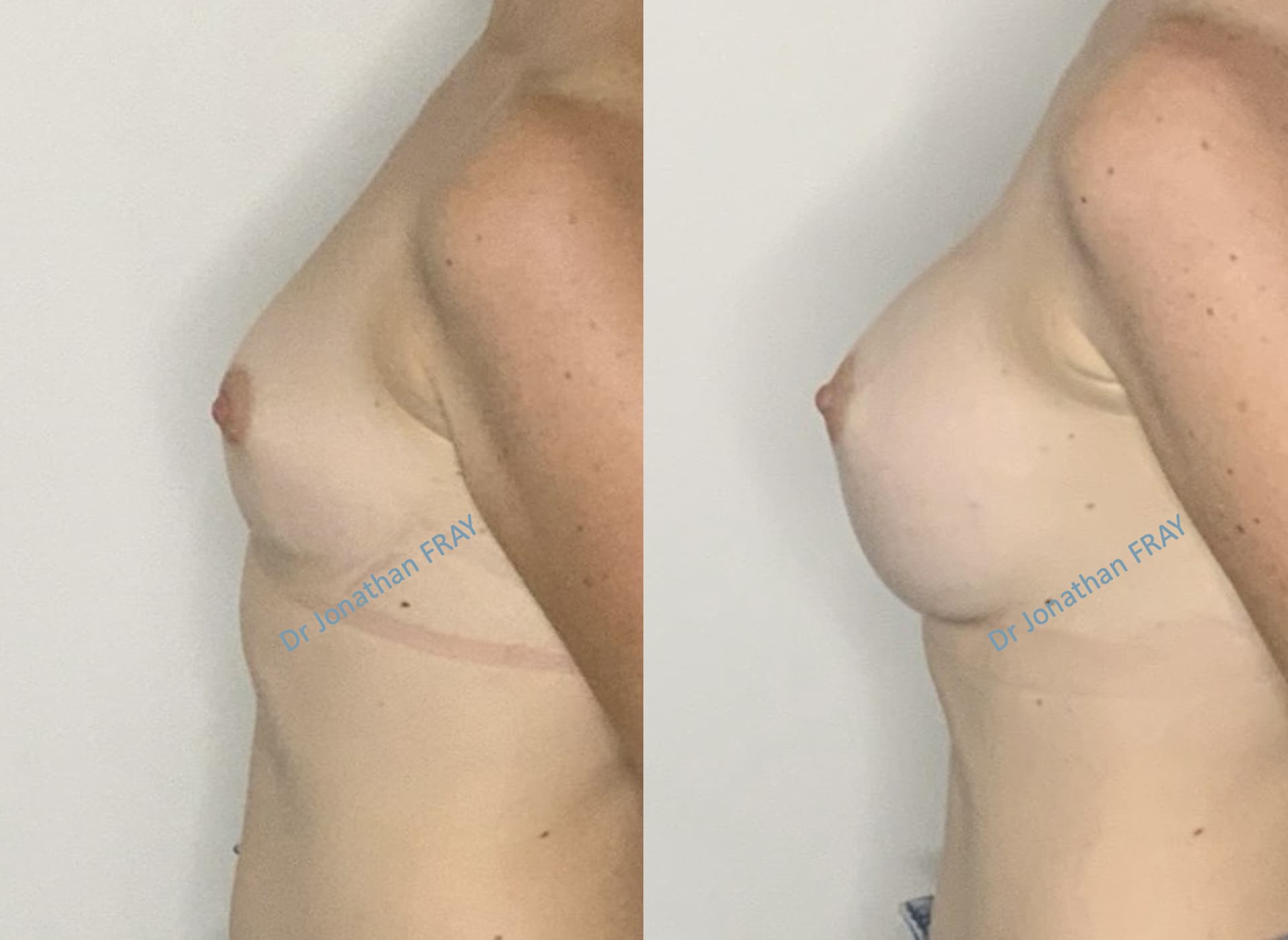 Photos avant après d'une augmentation mammaire par implants réalisée par le Dr Fray à La Réunion - Vue 1