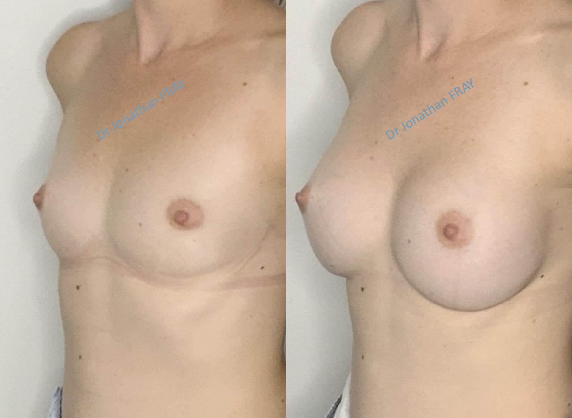 Photos avant après d'une augmentation mammaire par implants réalisée par le Dr Fray à La Réunion - Vue 2