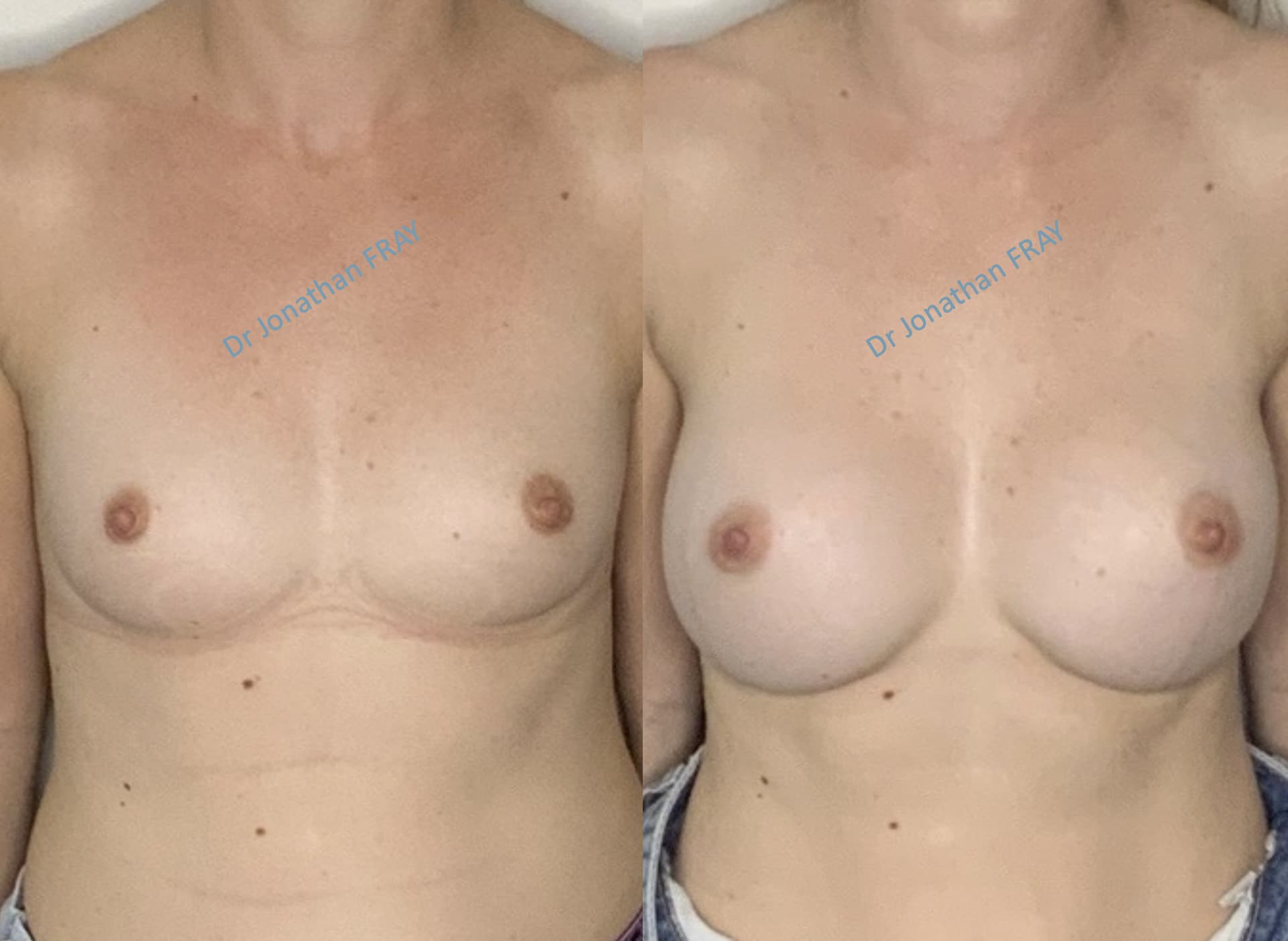 Photos avant après d'une augmentation mammaire par implants réalisée par le Dr Fray à La Réunion - Vue 3
