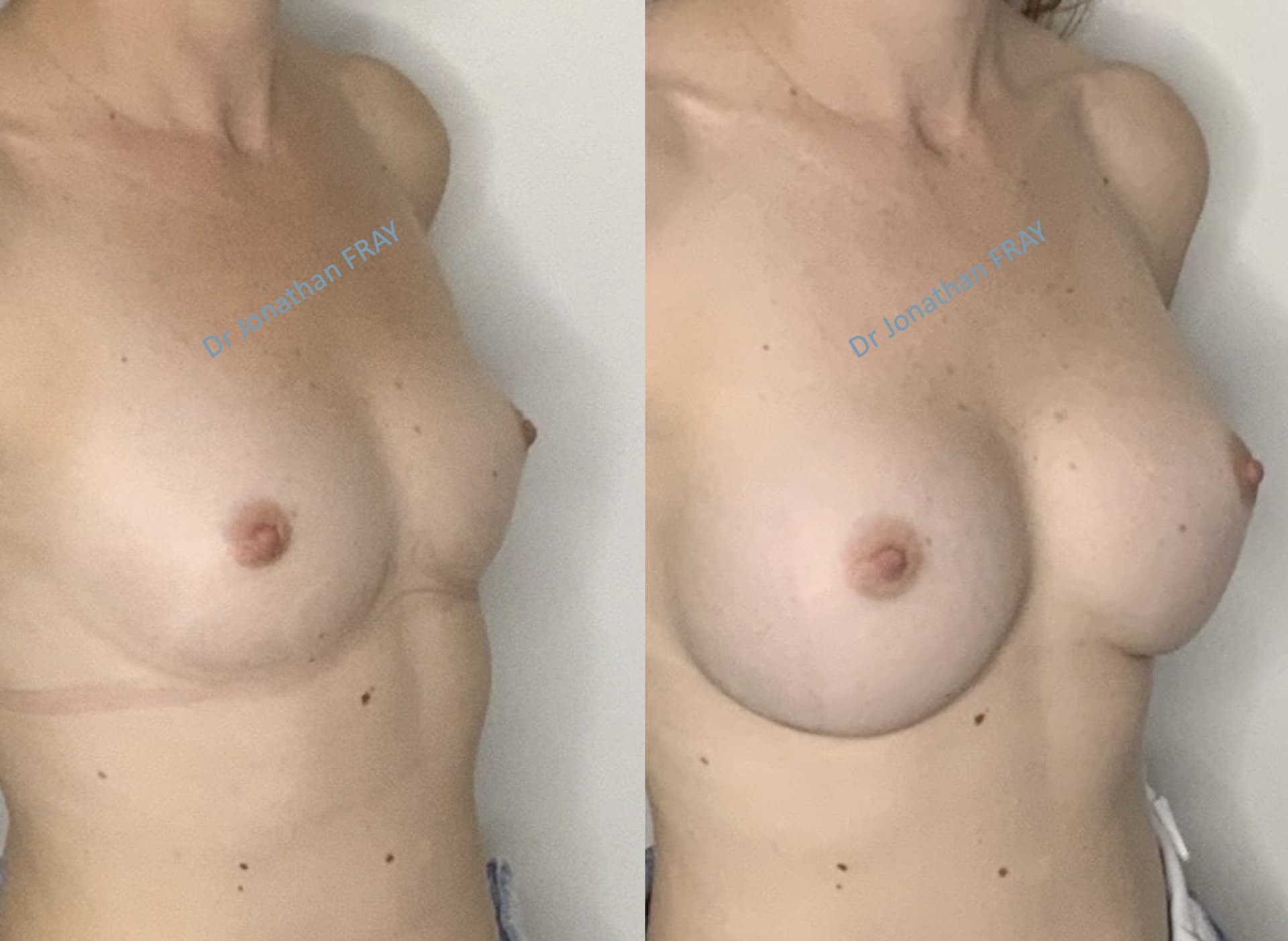 Photos avant après d'une augmentation mammaire par implants réalisée par le Dr Fray à La Réunion - Vue 5