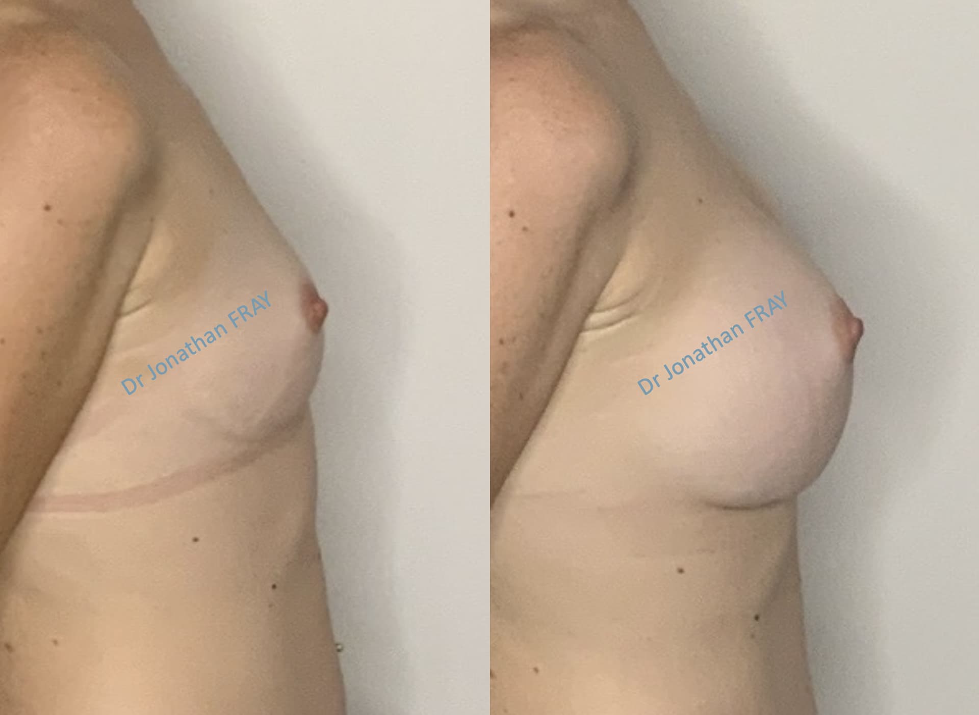 Photos avant après d'une augmentation mammaire par implants réalisée par le Dr Fray à La Réunion - Vue 6