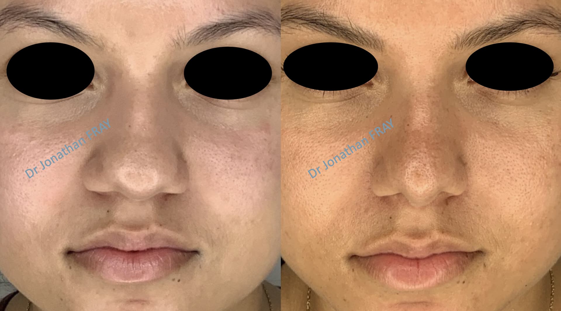 rhinoplastie-9-avant-apres-1 Résultat avant après d'une rhinoplastie vue de face